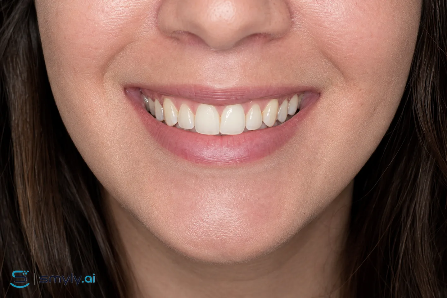 Before: sample smile before small tooth buildup