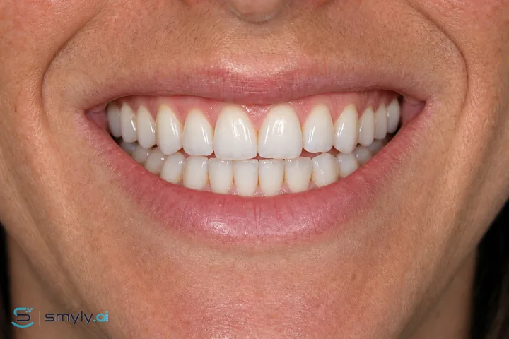 After: Smyly full smile makeover simulation