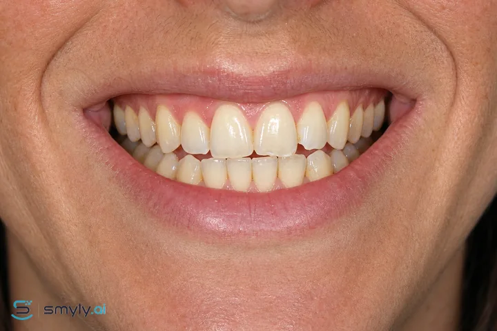 Before: the same smile, untreated